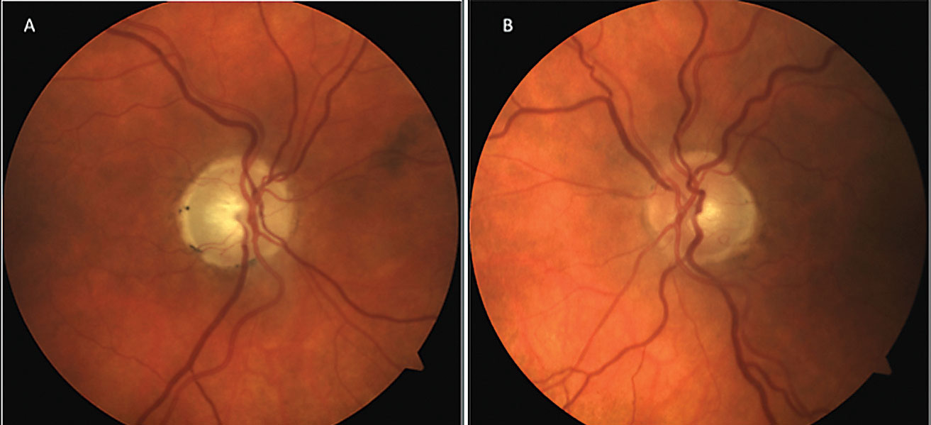The patient’s optic nerve fundus photo shows evident neuroretinal rim pallor OD (A) and early glaucomatous cupping OS (B).