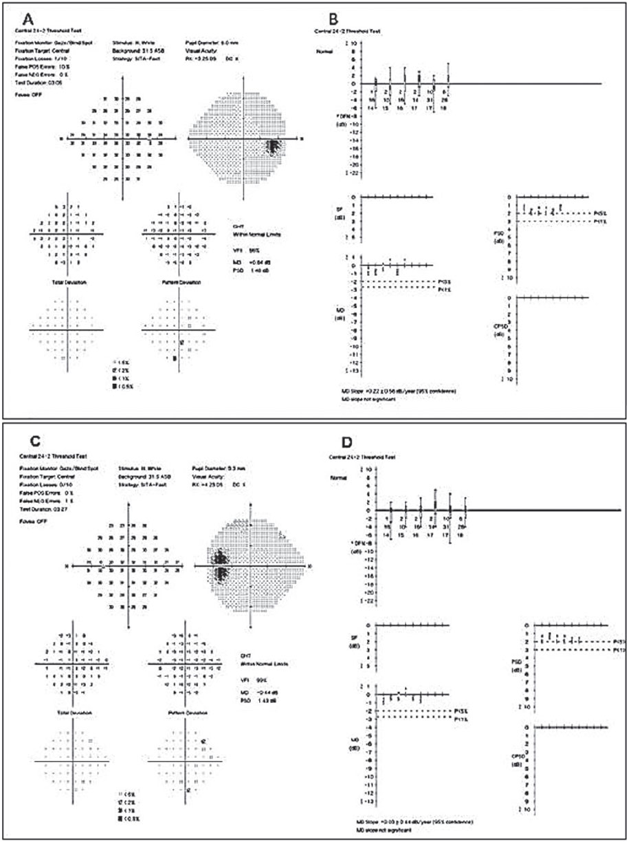 The patient’s most current SAP (24-2) visual fields show OD (A) and OS (C) being within normal limits and without glaucomatous defects. GPA slope OD (B) and OS (D) are stable to baseline, and the MD slope is “not significant.”