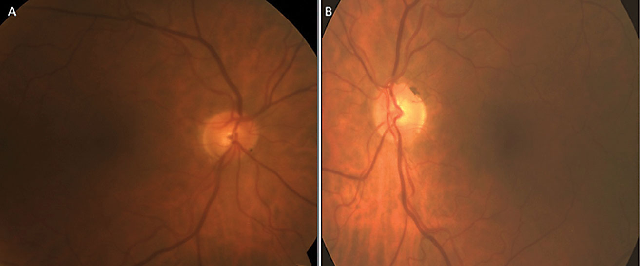 This optic nerve fundus photo reveals significant focal thinning at 7 o’clock OD (A) and moderate generalized cupping without focal rim thinning OS (B).