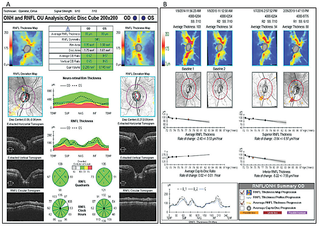 OCT RNFL analysis shows focal inferotemporal RNFL loss OD (A), while RNFL guided progression analysis shows steep negative slopes of the inferior RNFL thickness OD, more so than the average and superior thicknesses (B).