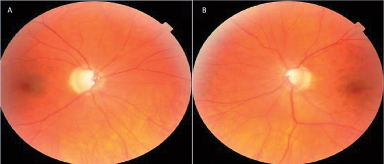 This patient’s optic nerve fundus photo indicates evidence of glaucomatous thinning and cupping, and papapapillary atrophy OD (A) and OS (B). 