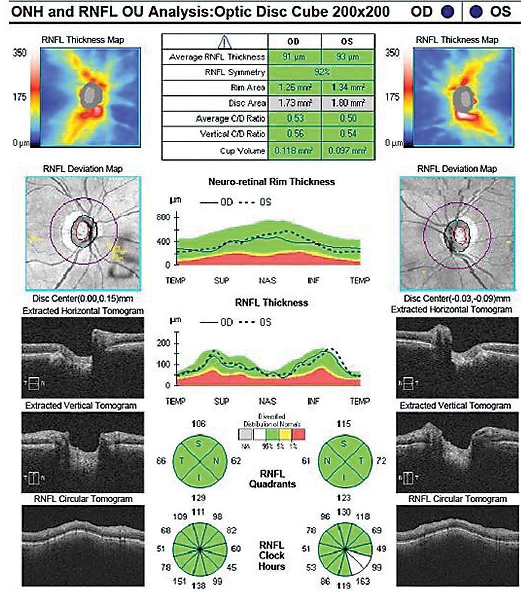 This retinal nerve fiber layer OCT scan shows a normal TSNIT graph, normal quadrant and sectoral tomogram, and robust thickness maps OU.