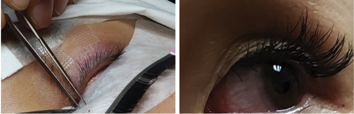Fig. 2. During (left) and after (right) an eyelash extension procedure. Note this patient’s ocular irritation post-application.