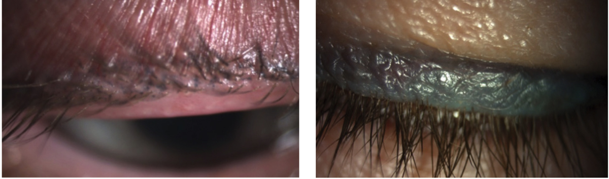 Fig. 5. Pigment fade (left) and spread (right), with the tattooed eyeliner extending upward further than the thin line originally applied, of permanent makeup. Both patients have dry eye with MGD.