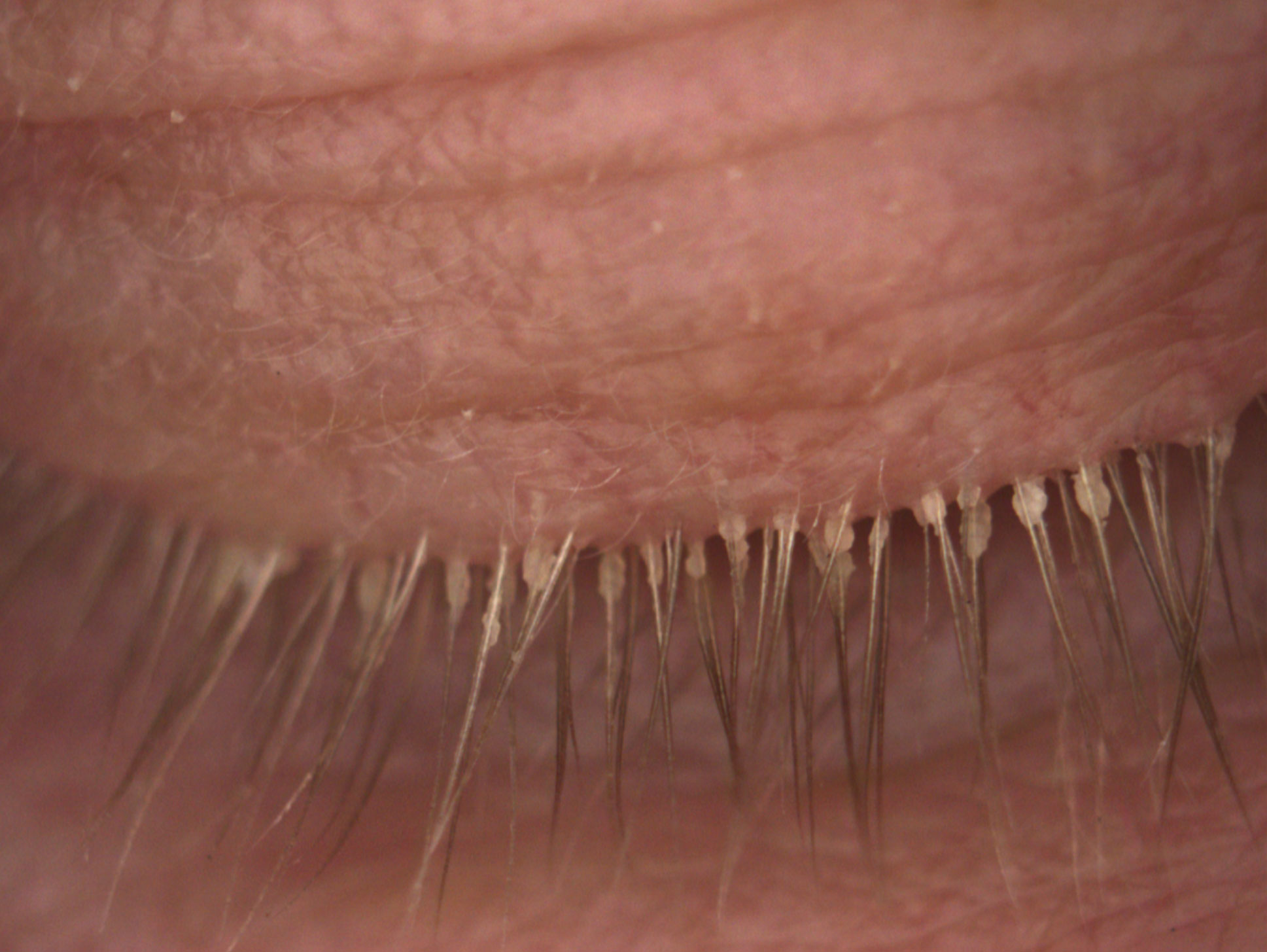 Fig. 2. This patient’s lashes show cylindrical dandruff secondary to the presence of Demodex.