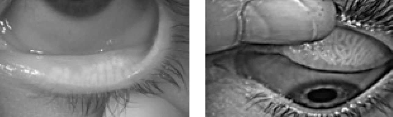 Fig. 3. These meibography images of an upper and lower lid demonstrate atrophy, truncation and tortuosity of the meibomian glands.
