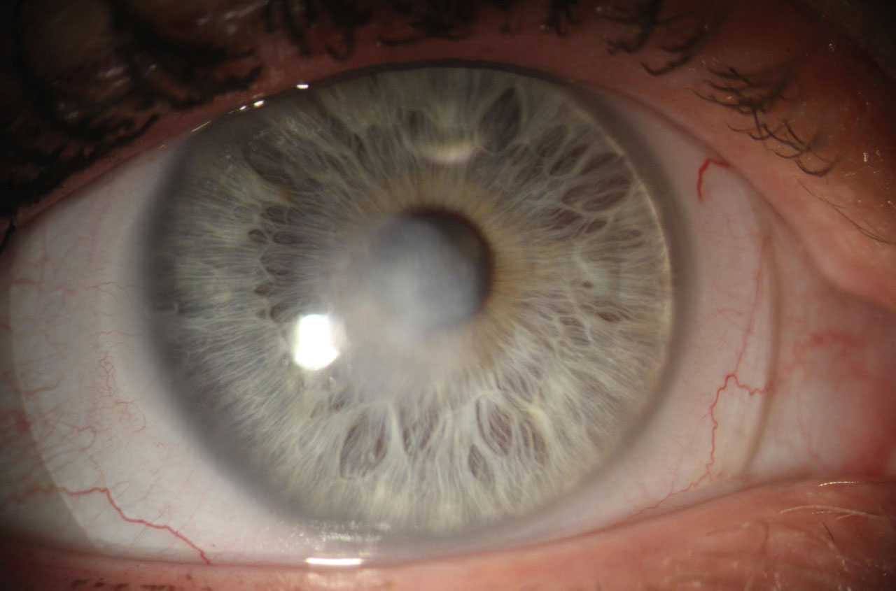 This cornea shows a central depressed opacity after the resolution of a fungal ulcer. Note the scleral lens.