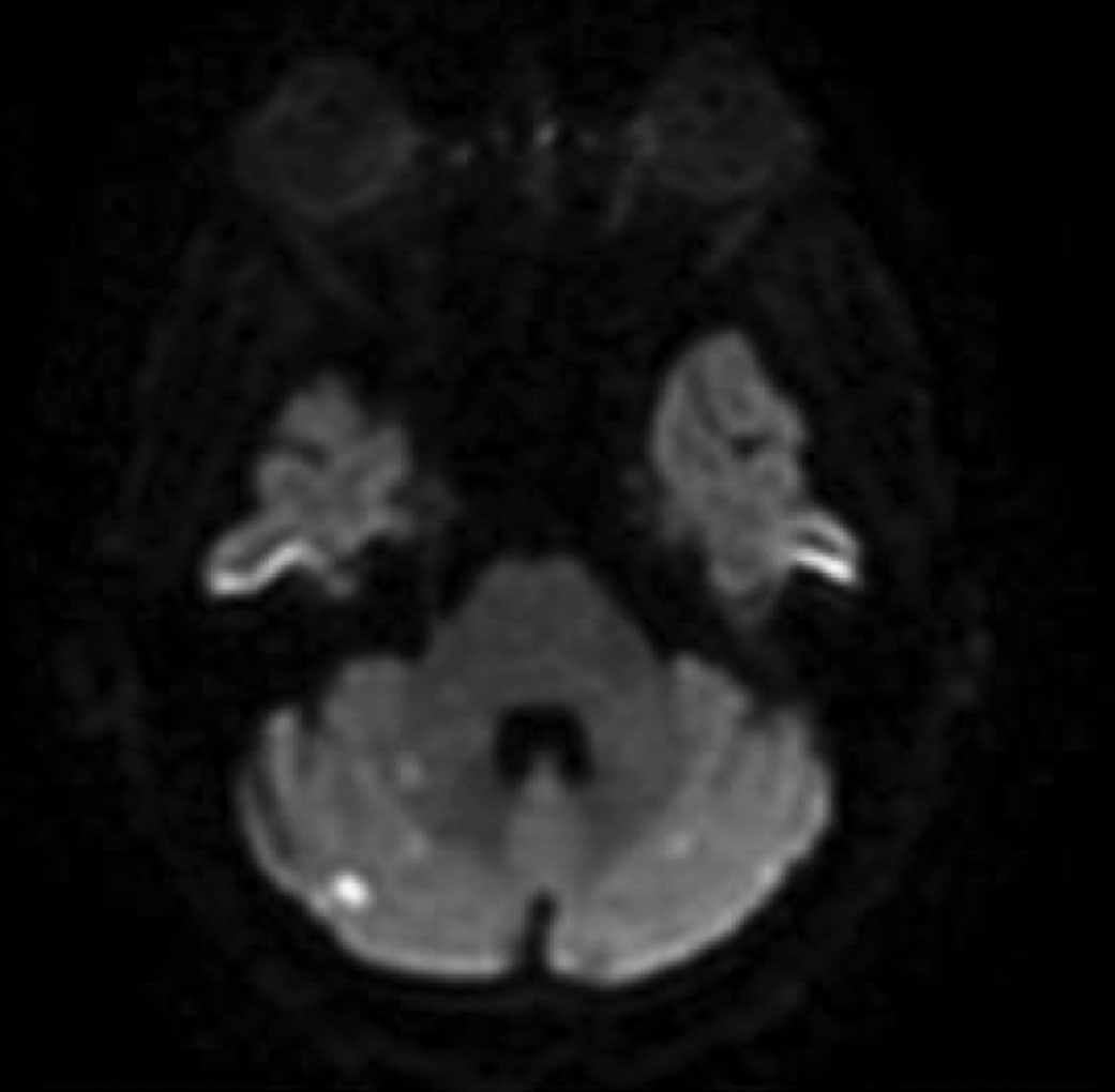 DWI of the brain reflecting areas of hyperintensity that correlate with lesions of acute infarct.