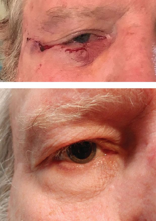 This patient had BCC of the lower eyelid. Above is the immediate post-op s/p Mohs micrographic surgery with Tenzel closure. At right is one year post-op.