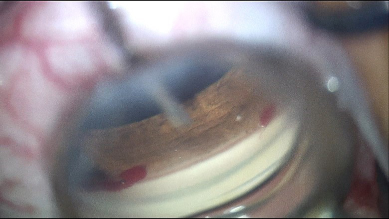 iStent inject insertion directly following cataract surgery.