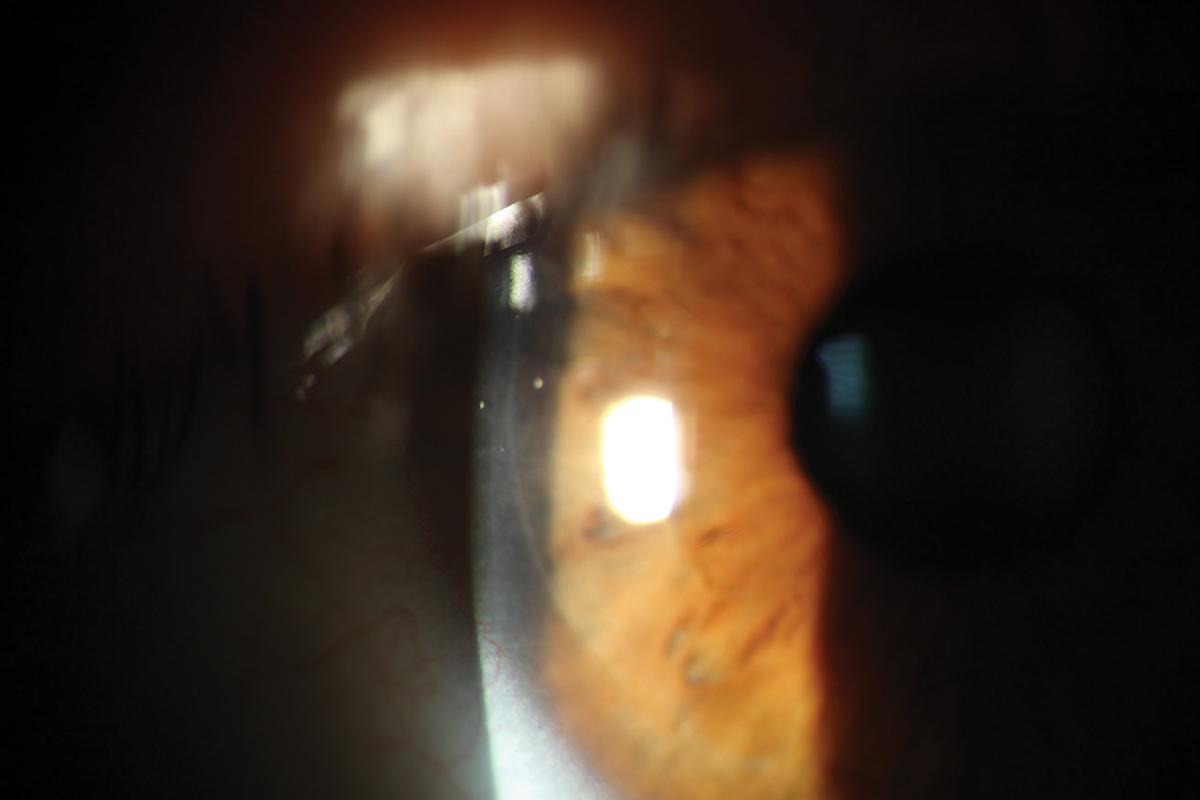 A clear, well-adhered LASIK flap seen one day postoperatively.
