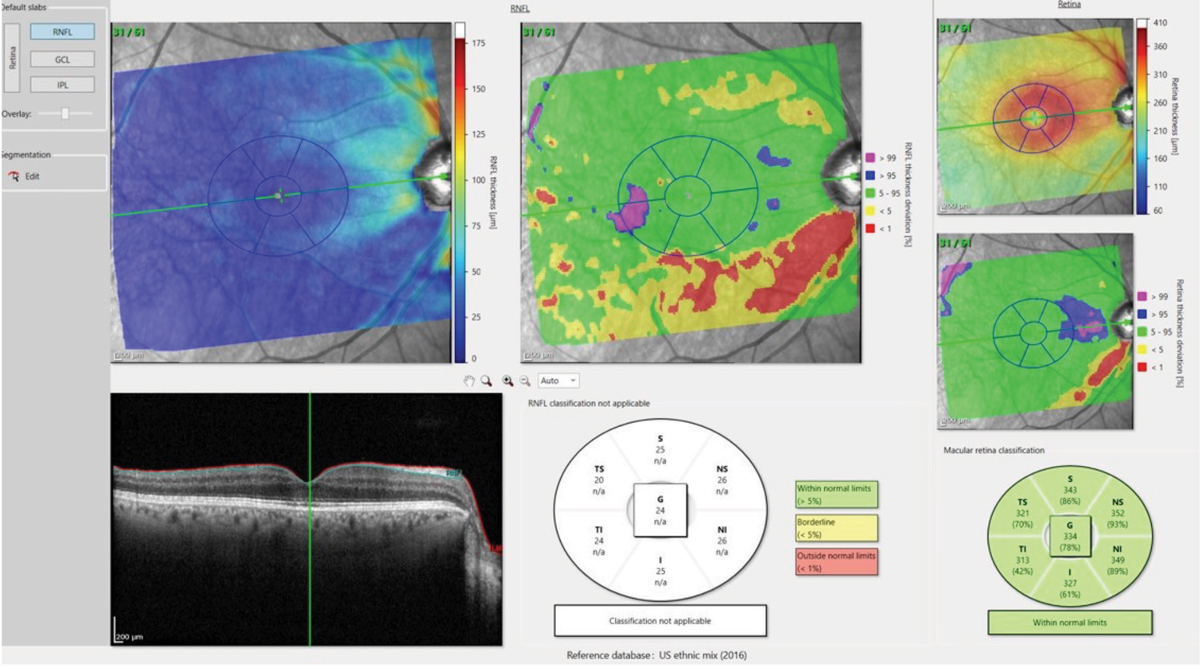 Figs. 4a and 4b. The deviation map in 4a (above) highlights an area in the temporal, inferior macula of loss of ganglion cell bodies, which matches up nicely with figure 4b (below), which shows the comparable damaged RNFL axons in the same eye.