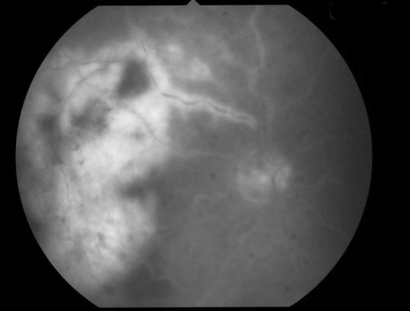 Fig. 3. Fluorescein angiography, seen here, can help identify filling defects of the retinal arteries caused by an occlusion.