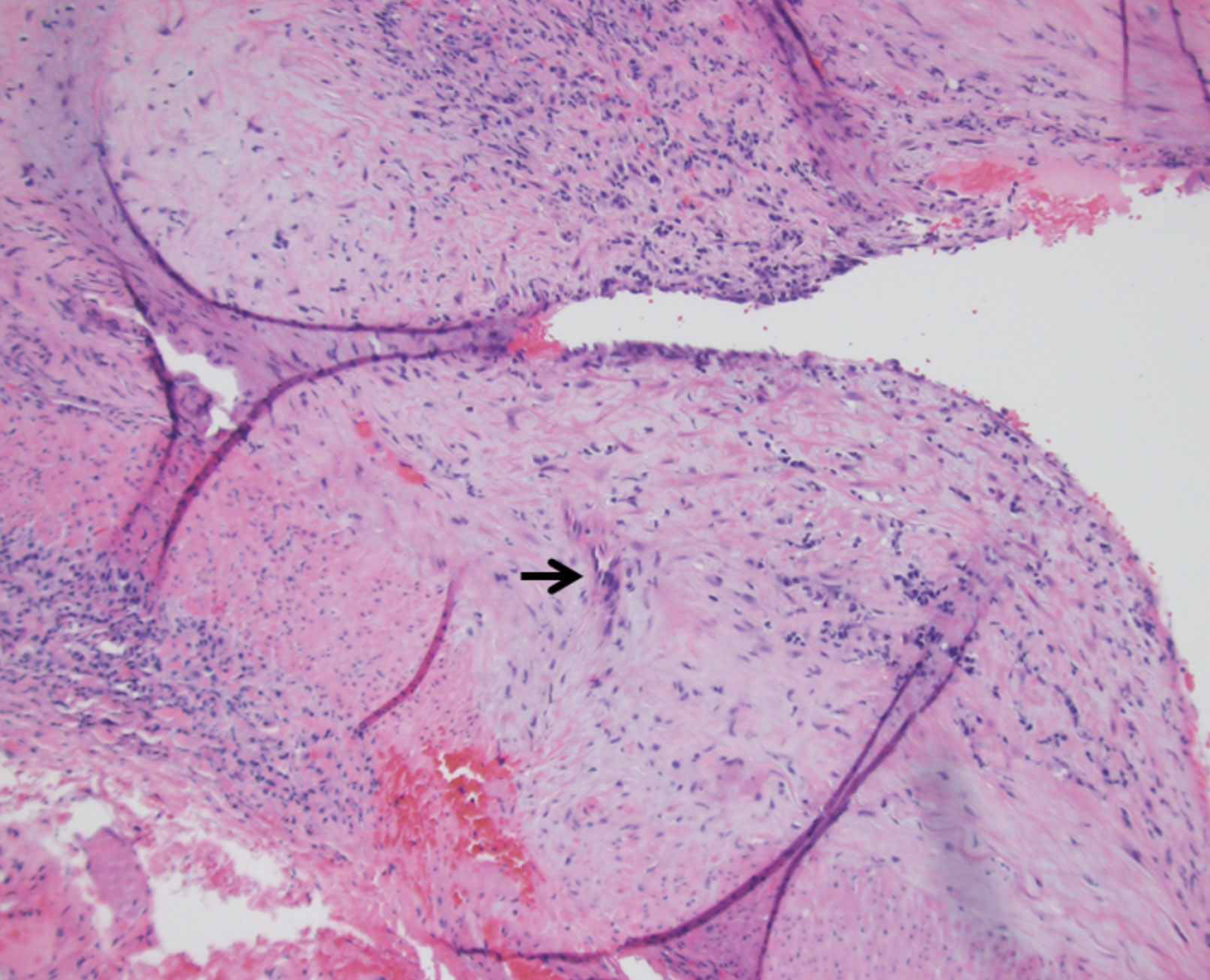 Fig. 5. Histology shows a specimen affected by temporal arteritis (the arrow indicates a multinucleated giant cell).