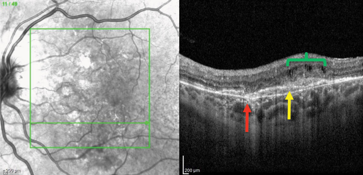 Fig. 2. OCT of the left eye demonstrates a break in Bruch’s membrane (red arrow), a shallow pigment epithelial detachment with overlying subretinal hyper-reflective material (yellow arrow) and cystoid macular edema (green bracket).