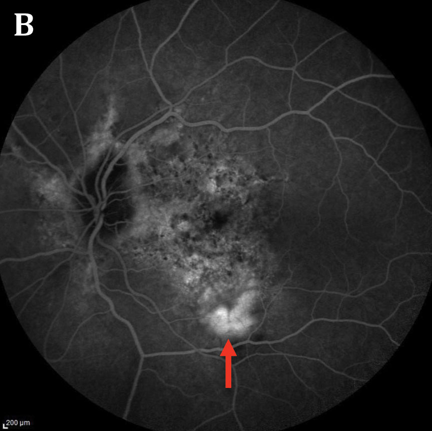 Fig. 3. The patient’s fluorescein angiography of the left eye (A) shows early hyperfluorescence noted inferior to fovea with late leakage (B). Angioid streaks surrounding the nerve can also be seen as staining. 