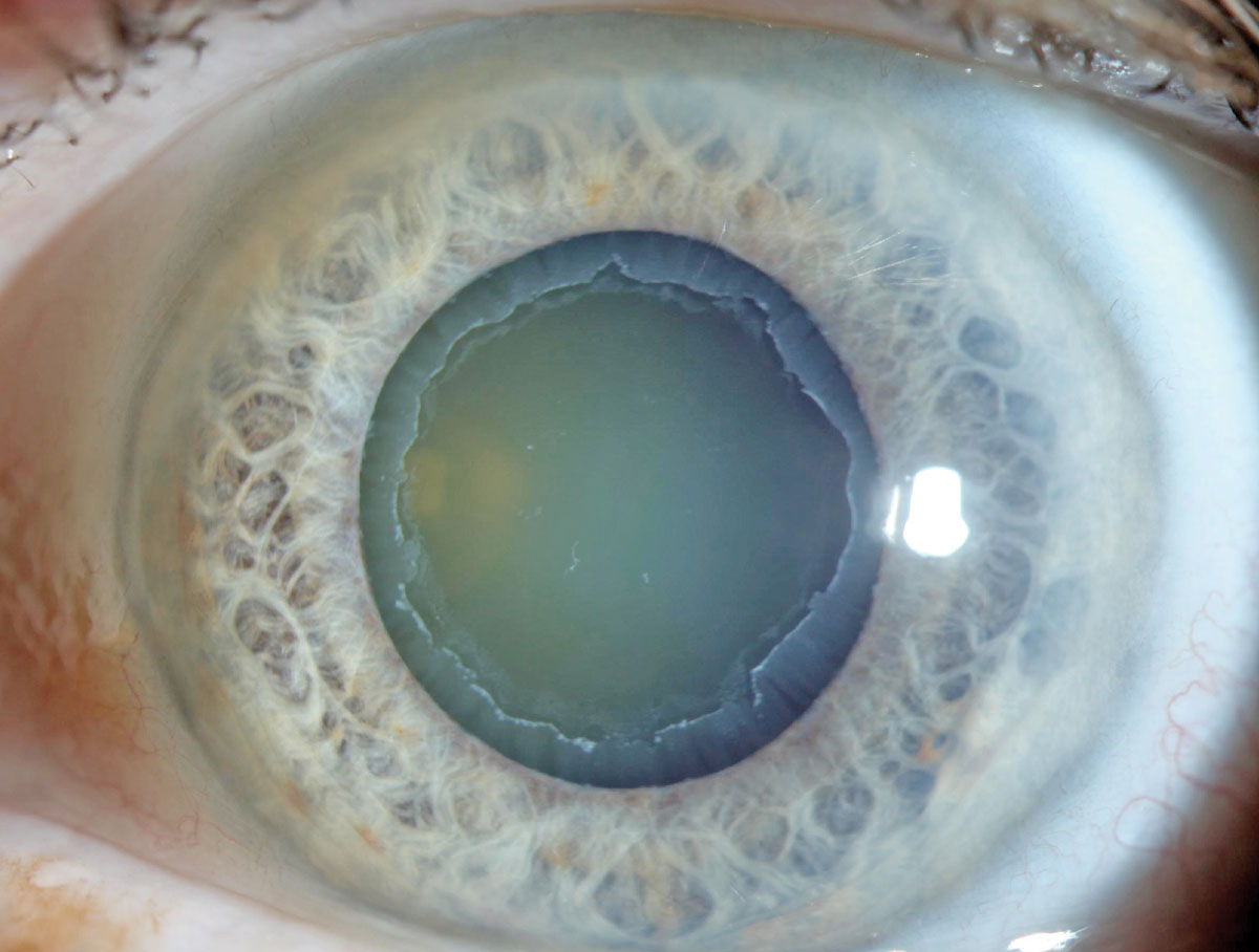 Pseudoexfoliation can cause difficulty in IOL placement. Due to association with weak zonules, specialty lenses are contraindicated in these patients.