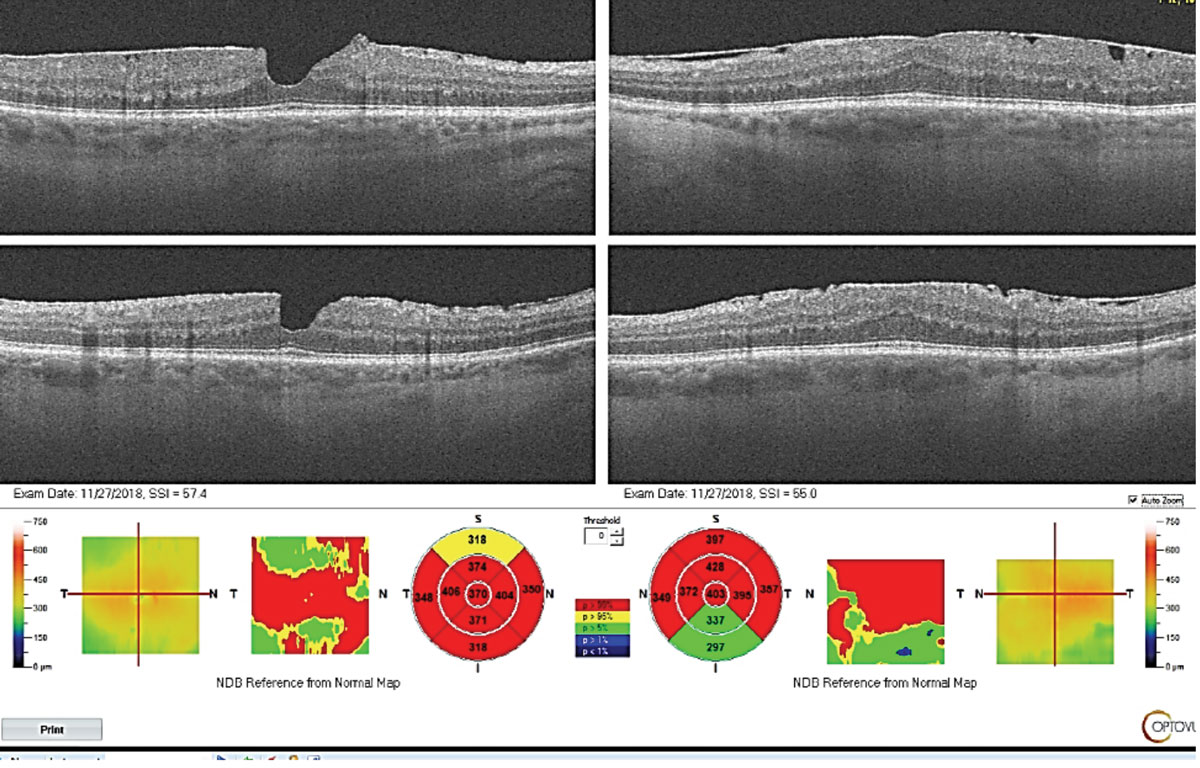 Epiretinal membrane is a contraindication for proceeding with premium IOLs as the patient’s acuity post-operatively is likely limited. In addition, patients are at elevated risk for post-operative cystoid macular edema.