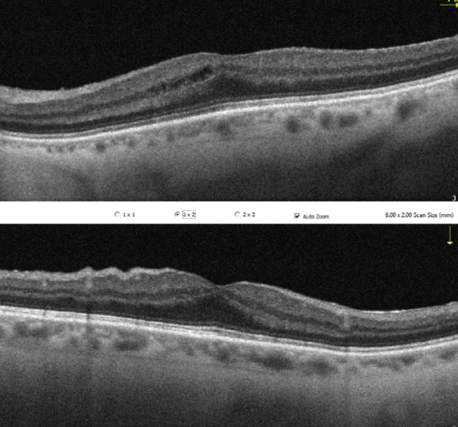 Irvine-Gass syndrome 1.5 months following cataract surgery. Prompt treatment with an NSAID and steroid typically results in a good prognosis and full resolution in a few weeks.