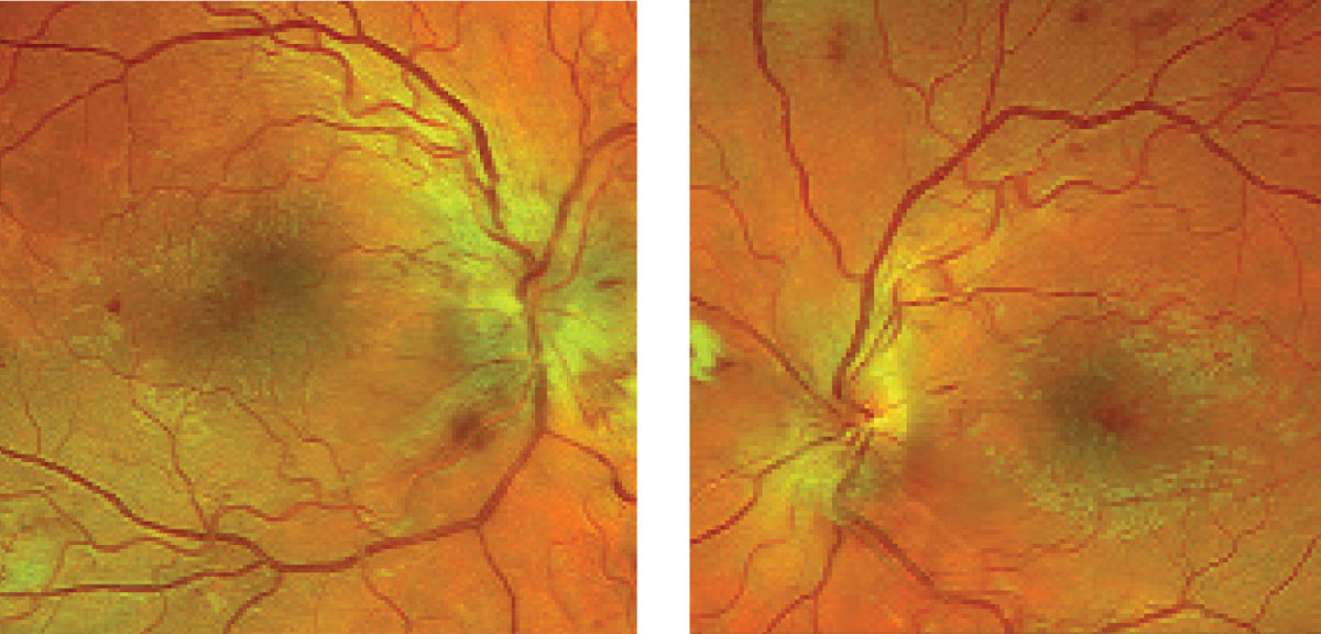 What structural changes can these images of the right (at left) and left fundus reveal, and can it help explain this kidney disease patient’s visual presentation?