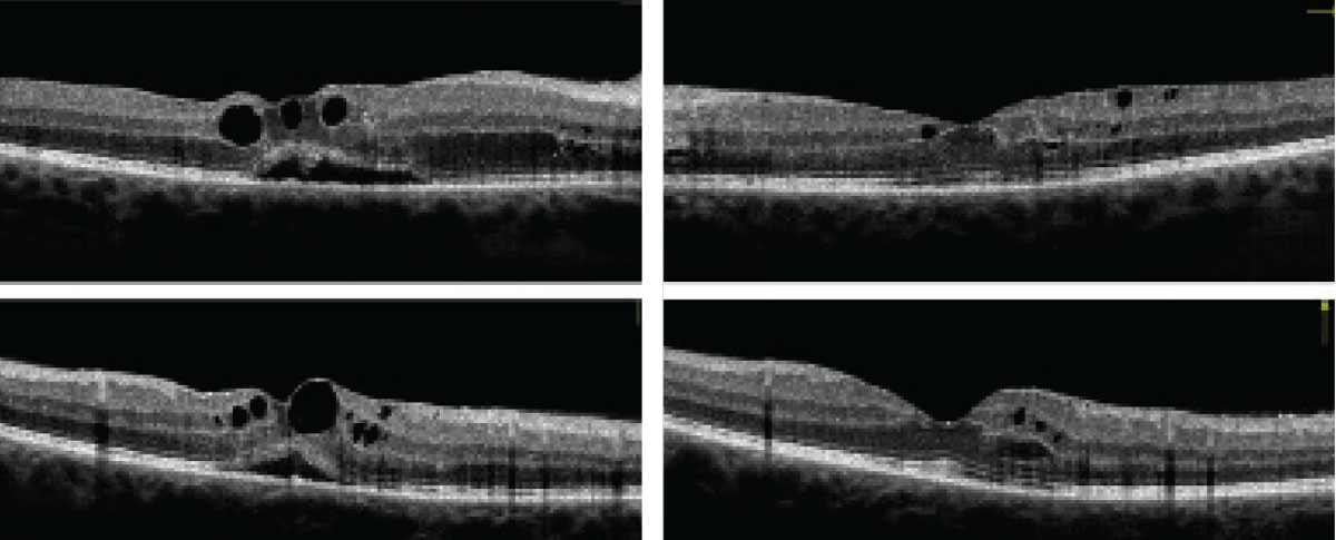 Can these OCT images of the right (at left) and left eyes reveal our 34-year-old patient’s diagnosis?