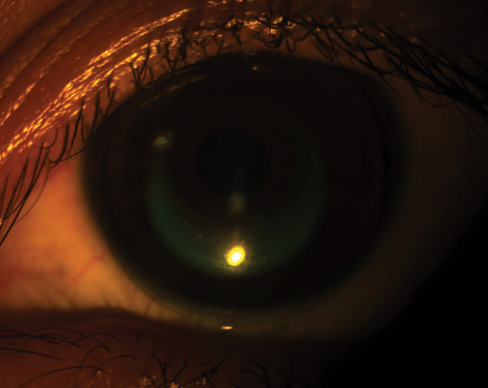 This patient demonstrates a well-fit orthokeratology lens.