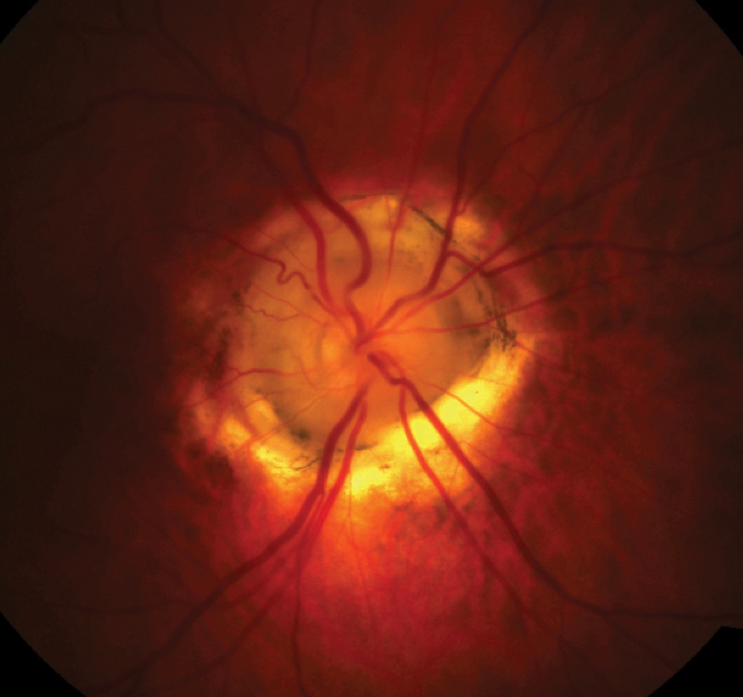 Fig. 1. Enlarged, excavated optic nerve with glial tissue and anomalous retinal vessels.