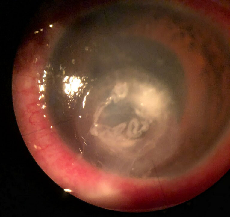 Determining the nature of a white corneal lesion requires a closer look.
