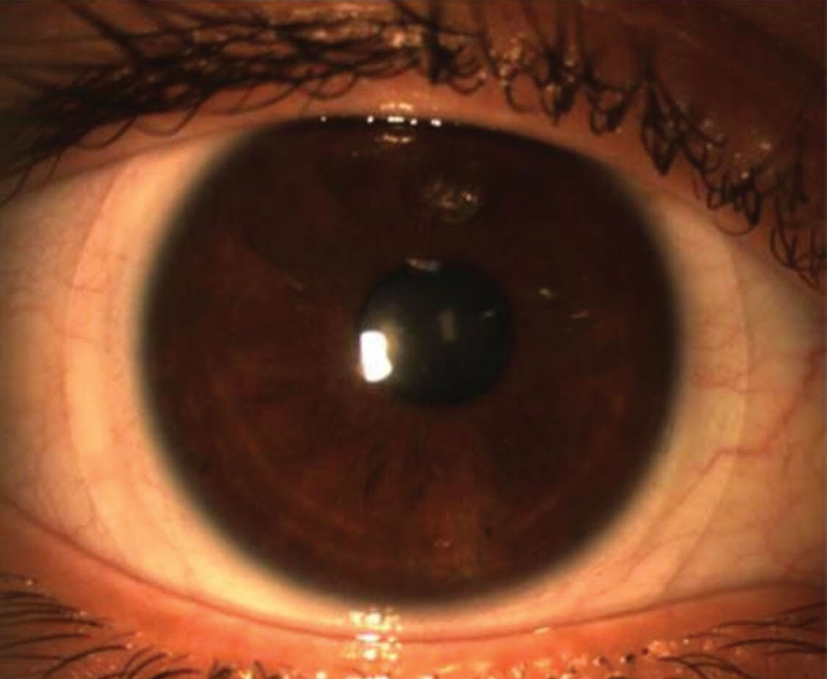 Scleral lenses could help address presbyopia and dry eye. 