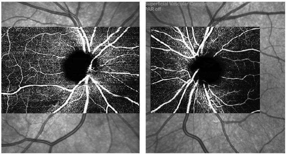 Fig. 3. OCT-A scans OD/OS from the Spectralis showing mild superotemporal capillary dropout OD.