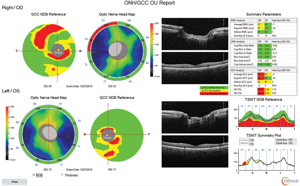 Fig. 7. This report from the Optovue Avanti includes numerous parameters that can help assess a glaucoma patient. One nice addition: an actual live OCT scan of the macula is visible, in addition to the contour map, to help the clinician recognize correspondence to anatomical structures.