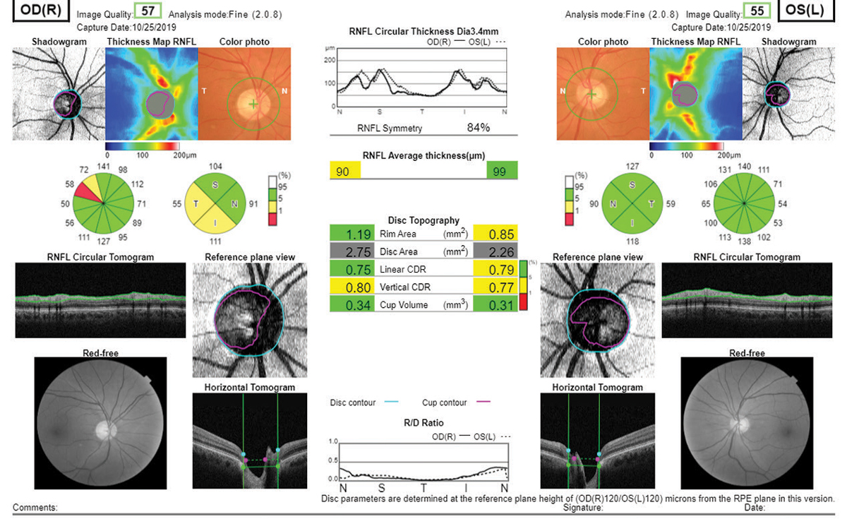 Fig. 9. Essentially every piece of diagnostic data a clinician might need is present in this Topcon Maestro2 report, including true color and red-free fundus photography.