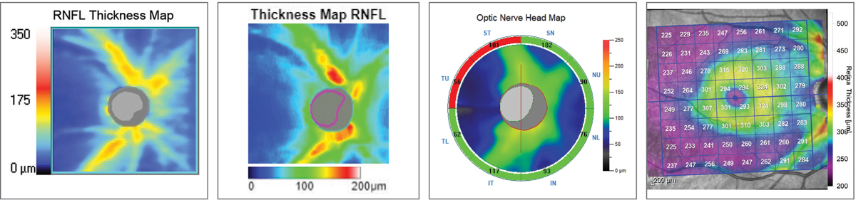 Fig. 10. RNFL thickness map comparison. Left to right: Zeiss Cirrus 6000, Topcon Maestro2, Optovue Avanti, Heidelberg Spectralis. The colors represent deviation from each device’s normative database. The Topcon and Zeiss images highlight the RNFL wedge defect by the blue streaks superotemporally. All four instruments will ultimately detect the RNFL defect, but it comes down to personal preference in how you use the data and visuals to get there.