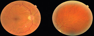 This patient had a Hollenhorst plaque in the superior-temporal arcade of each eye and a cotton-wool spot inferior-temporal to the right optic nerve. He had 70% to 99% stenosis of the right carotid artery and insignificant disease on the left. His echocardiogram was unremarkable. He underwent right carotid endarterectomy.