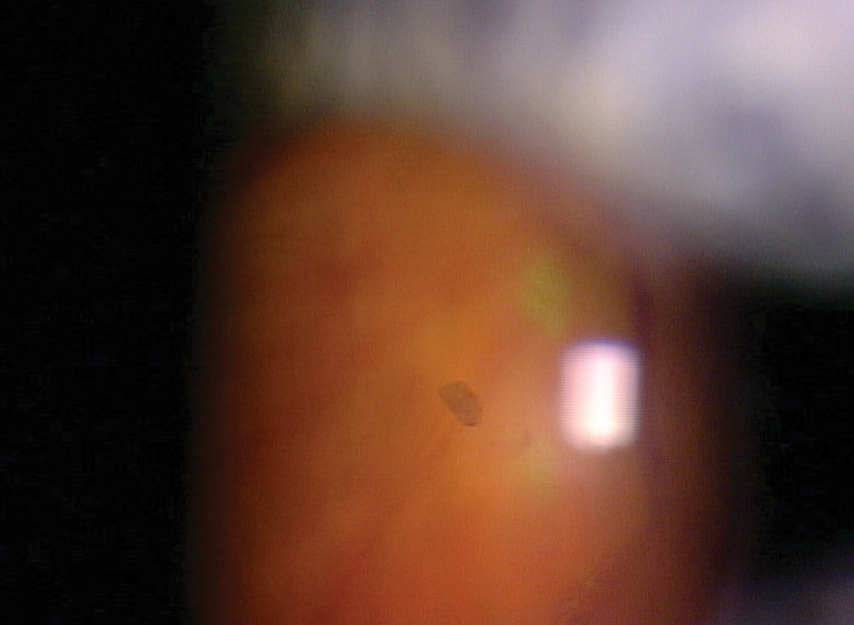This patient is about to undergo nd:YAG vitreolysis which will address an influx of floaters. For some patients, this procedure can relieve an irritating visual disturbance.