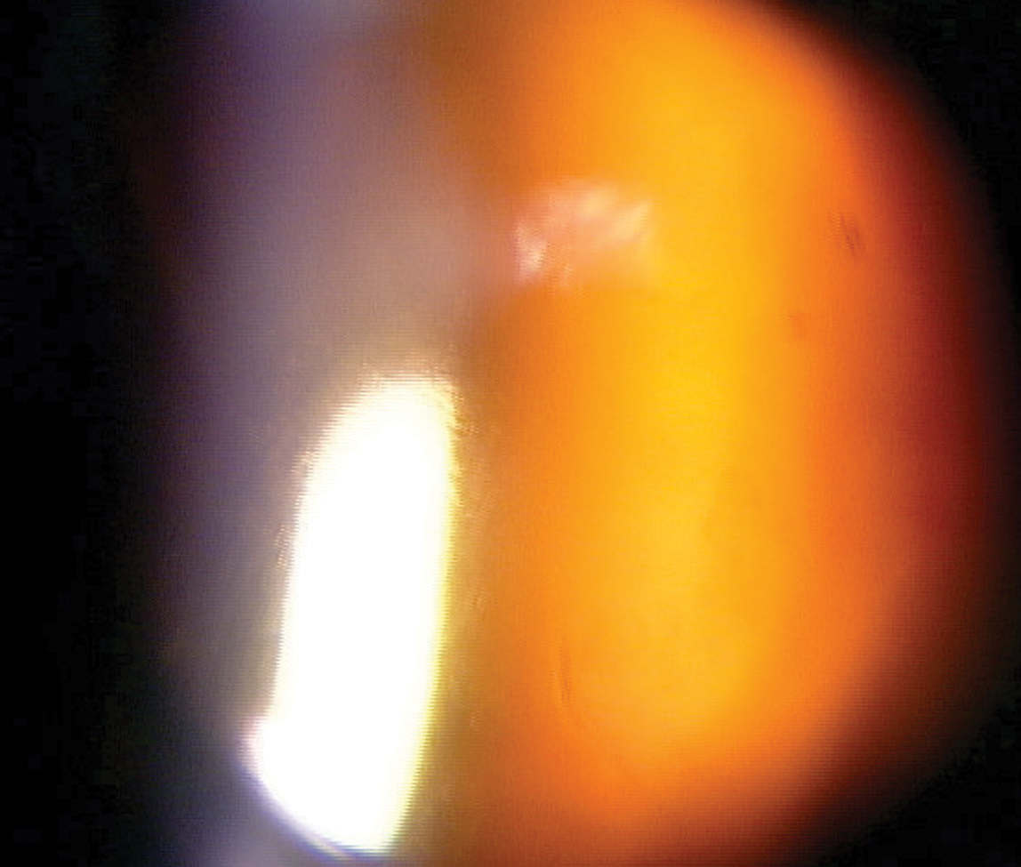 This photo shows our patient’s eye immediately following the procedure. At this point, the patient should wait in the office for at least 30 minutes so doctors can recheck their IOPs. 
