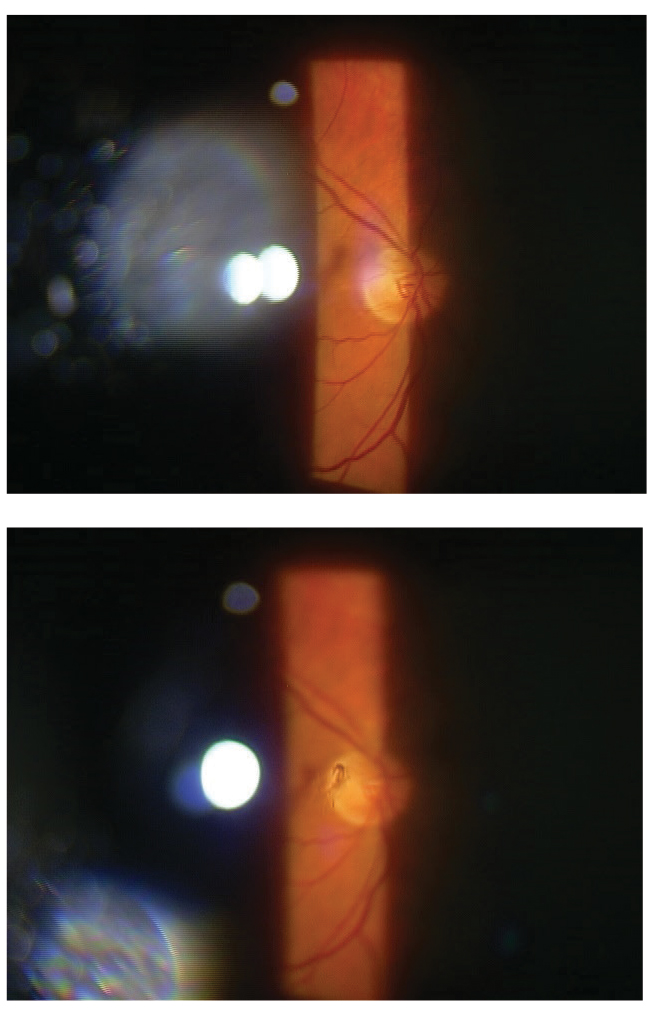 This patient has a partial Weiss ring with PVD that displays a shadow on their retina.