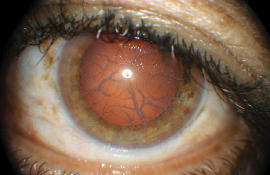 This patient’s anterior segment shows clear signs of lattice dystrophy. This potential consequence of LASIK can be avoided with a proper evaluation that now includes genetic testing.