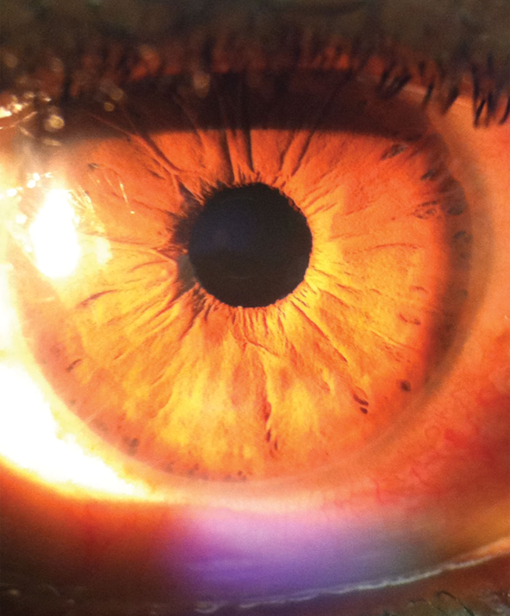 This photo of the patient’s anterior presentation shows her unusual ring-shaped opacities in the peripheral cornea.  