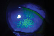 Sodium fluorescein staining shows this patient’s corneal surface is compromised by dry eye disease.