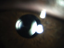In most cases, multifocal IOL rings are visible even through an undilated pupil, as seen here.