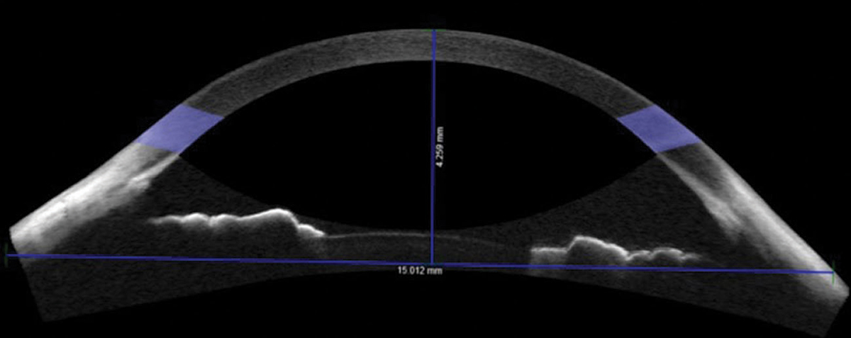 Fig. 1. Non-custom soft contact lenses didn’t fit right for this patient with a sagittal height of 4,259µm. Consider custom lenses in these cases.
