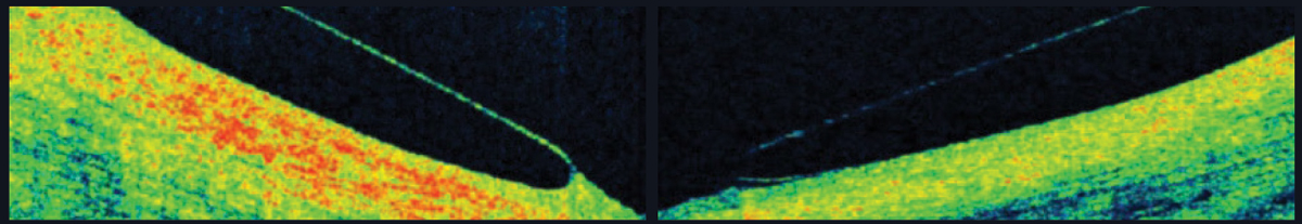 Fig. 6. AS-OCT shows a scleral lens edge with slight impingement into the conjunctiva (left) and an edge that lifts away from the conjunctiva (right).