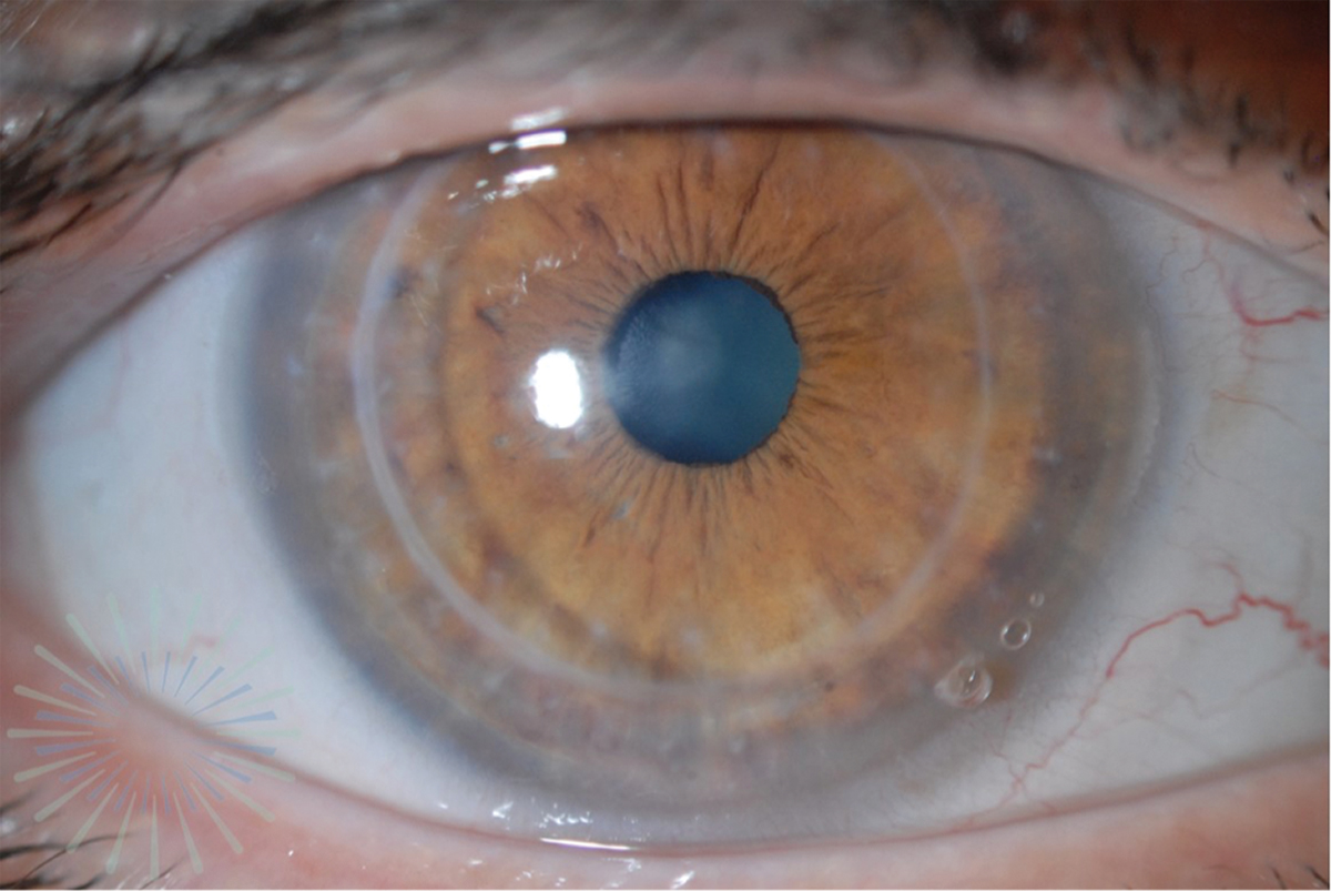 A large-diameter scleral lens with a fenestration at 4 o’clock is fit on a post-PK patient. 