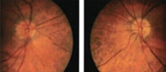 Both optic nerves are hyperemic and have blurred temporal margins, OD>OS.