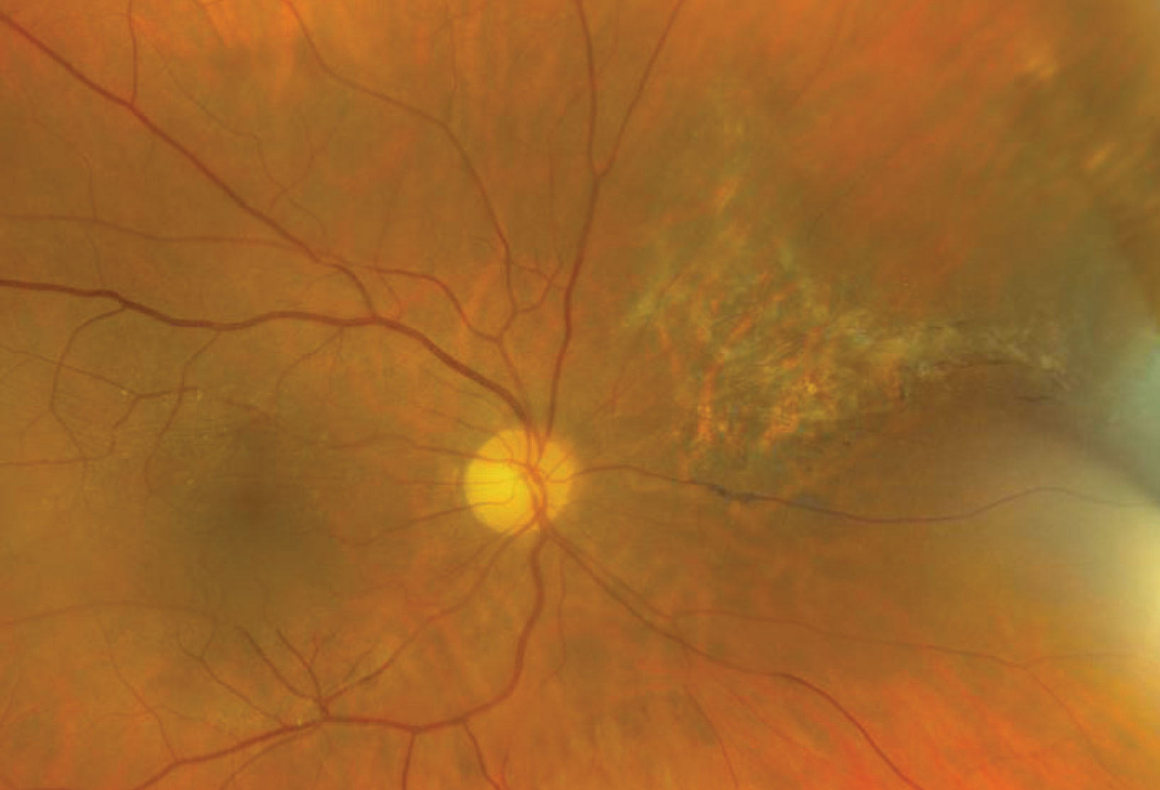 Here is our patient’s retina five years after initial diagnosis.