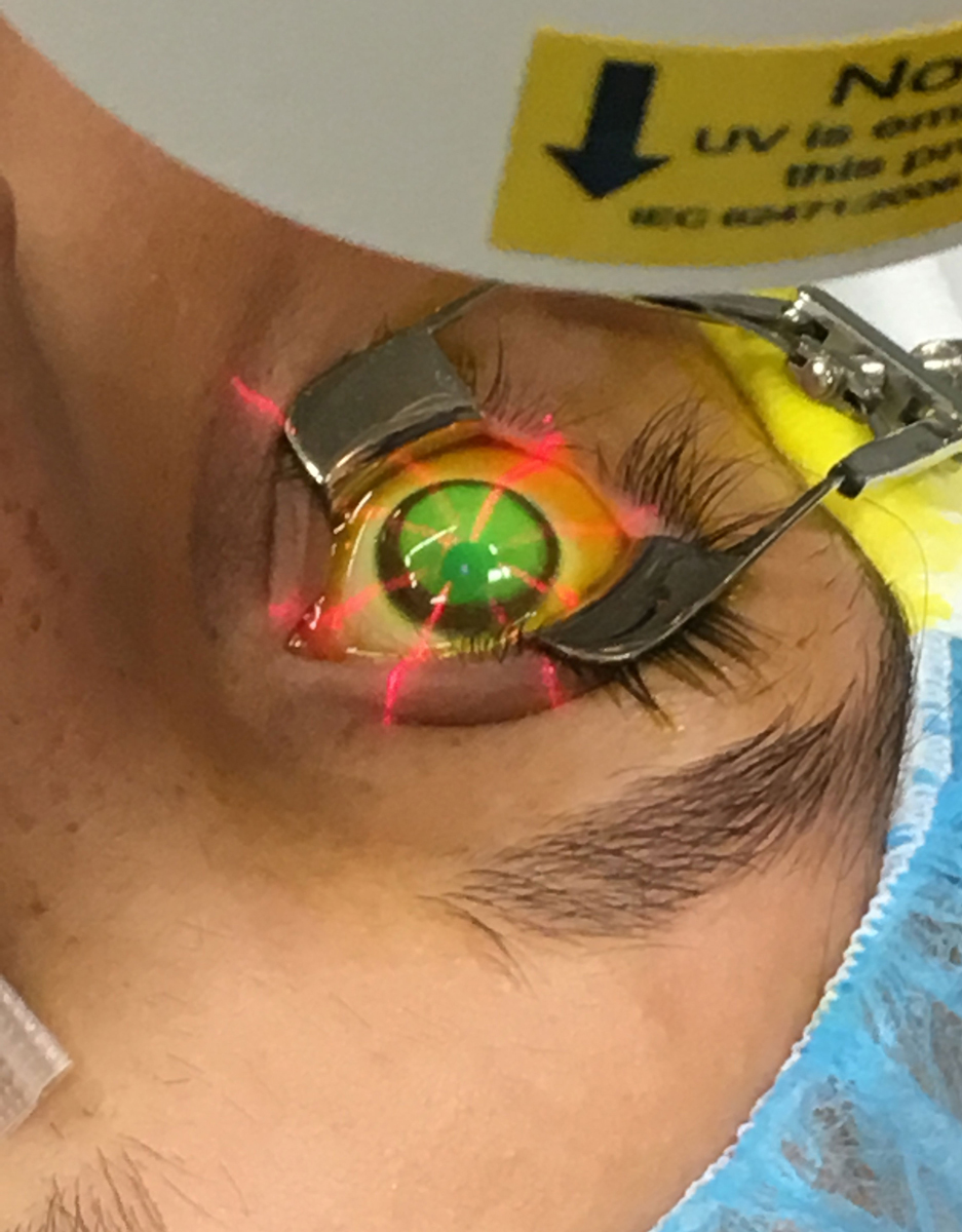 In this part of the procedure, UV light is focused on the eye for 30 minutes.