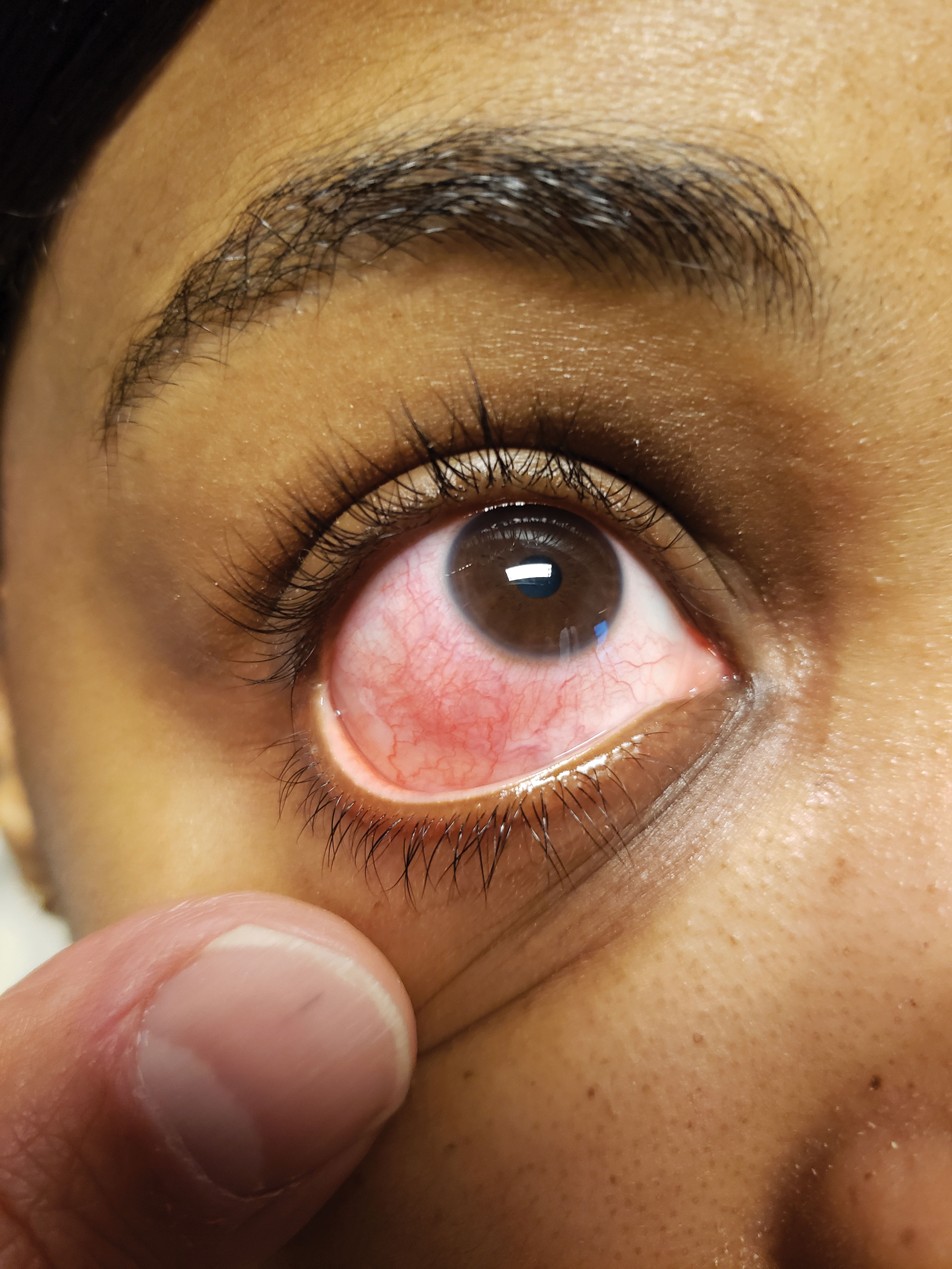 Consider underlying systemic conditions first before diagnosing episcleritis.