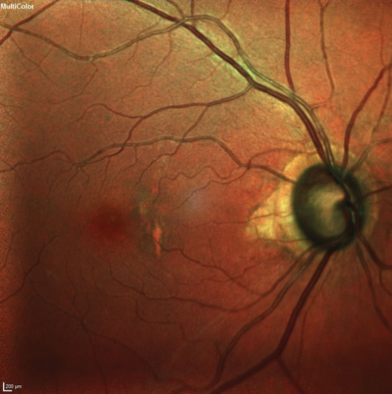 This 77-year-old patient’s fundus image shows advanced glaucomatous damage and macular changes consistent with her age.