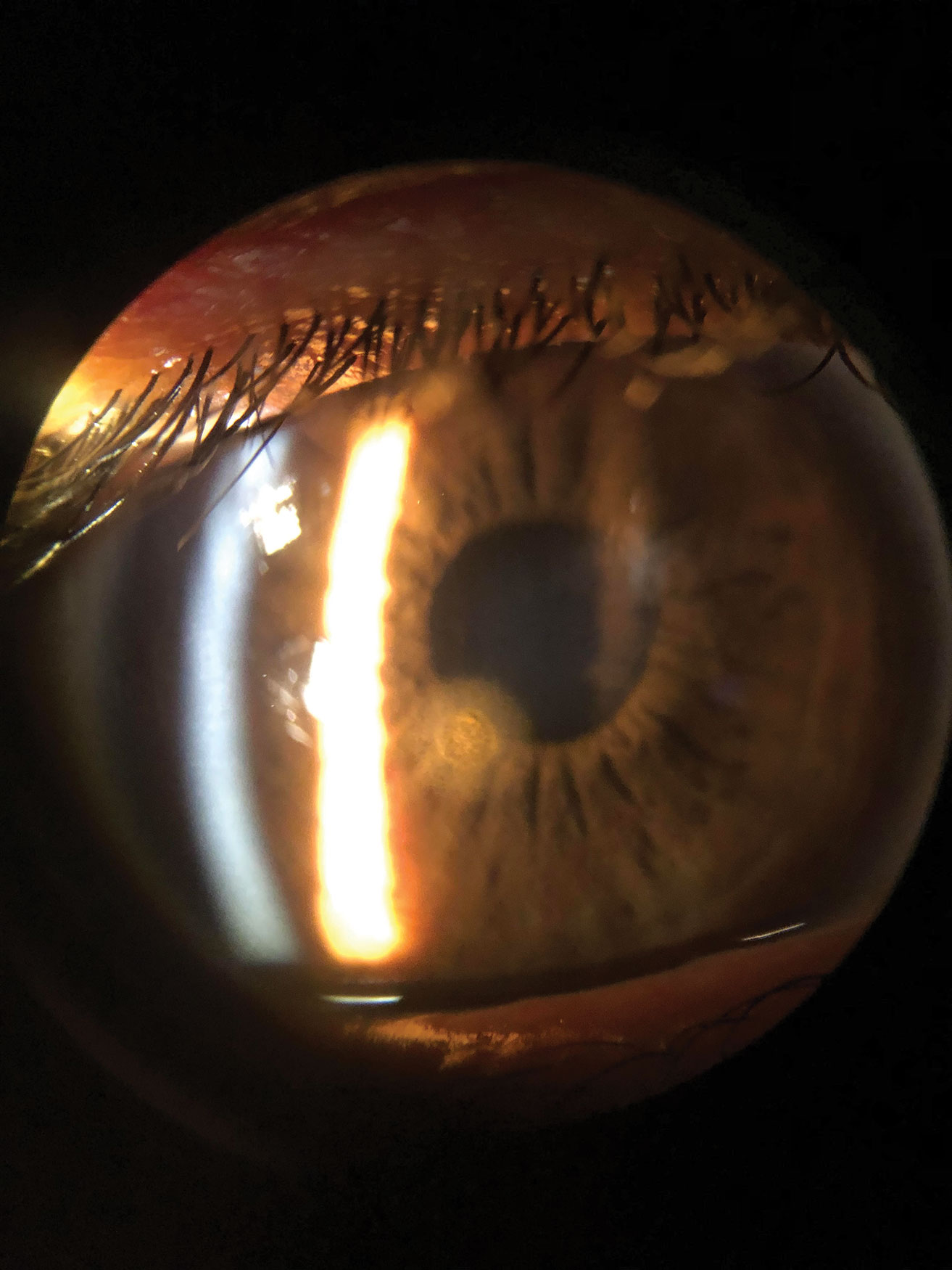 This is a patient’s cornea immediately after removal of a metallic foreign body but prior to rust ring removal. The object was superficial enough that it was removed with a sterile cotton swab after anesthetizing the patient’s eye.
